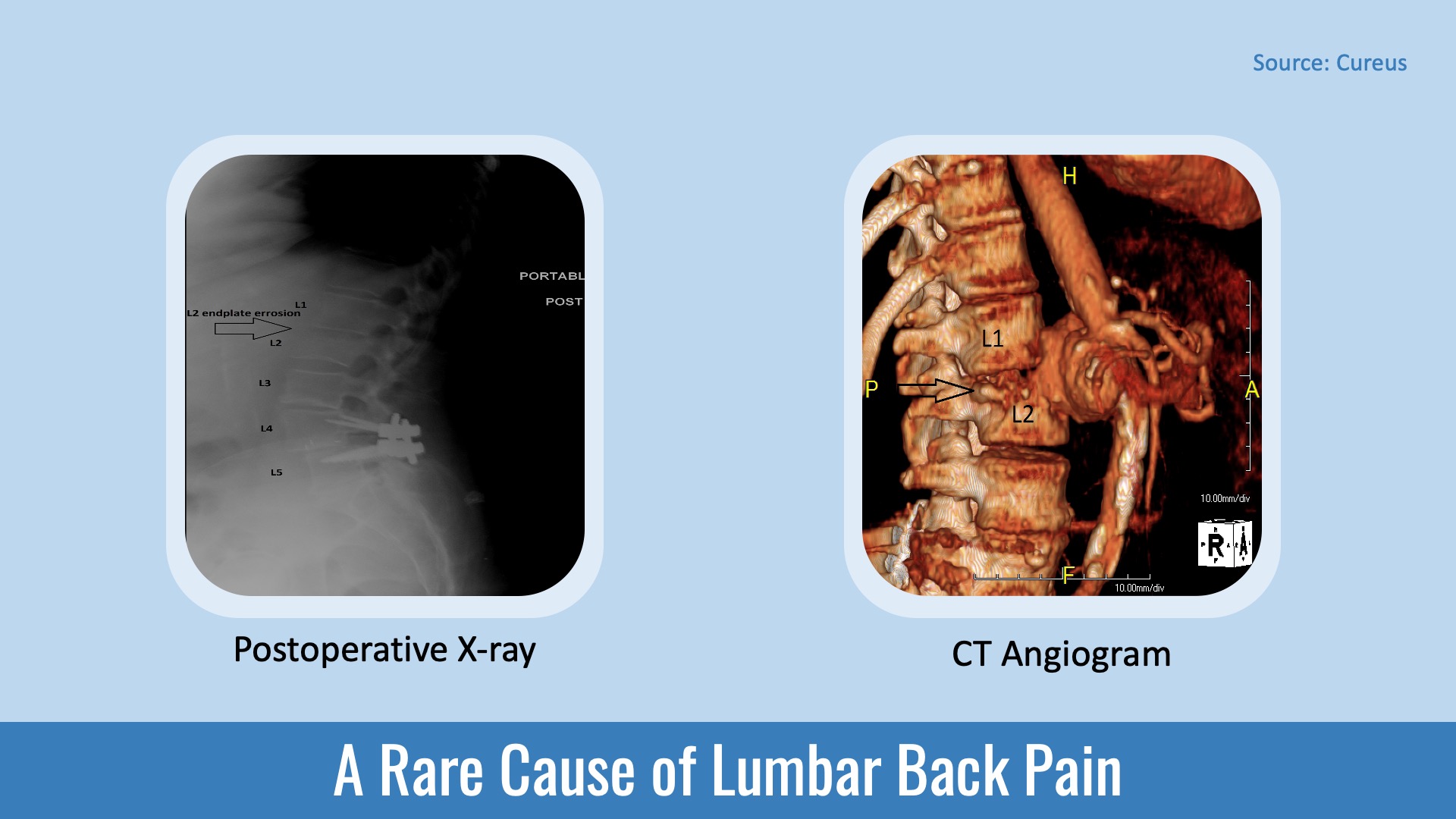 Identify the Rare Cause of Lumbar Back Pain in This Patient