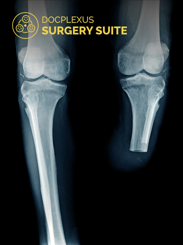 Rotationplasty: A Modified Amputation Surgery