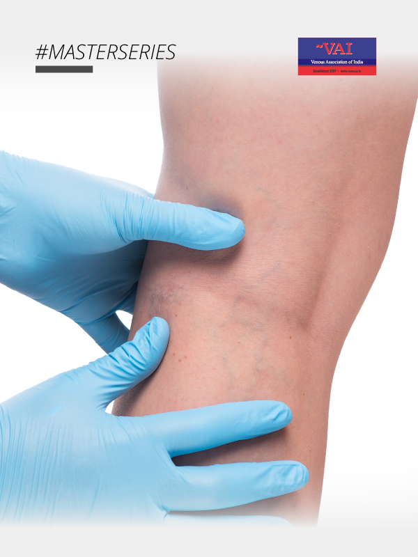 Venous Problems Faced By General Physicians in Everyday Practice
