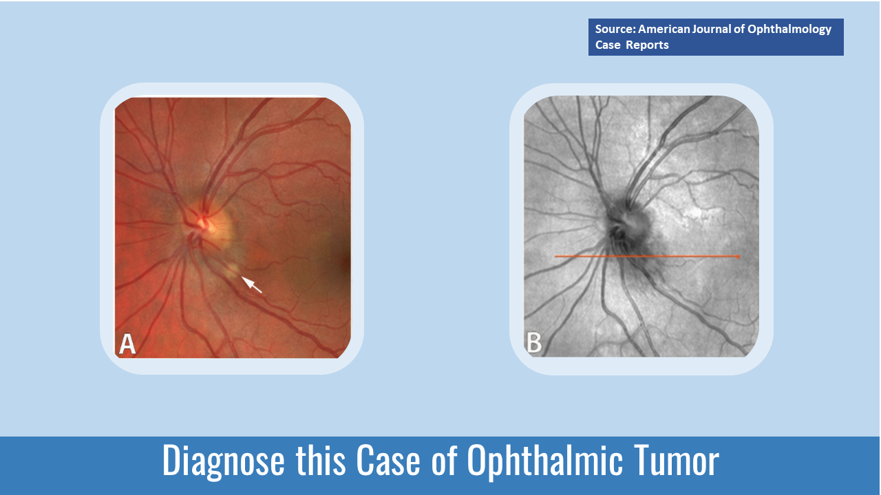 Identify this Ophthalmic Lesion