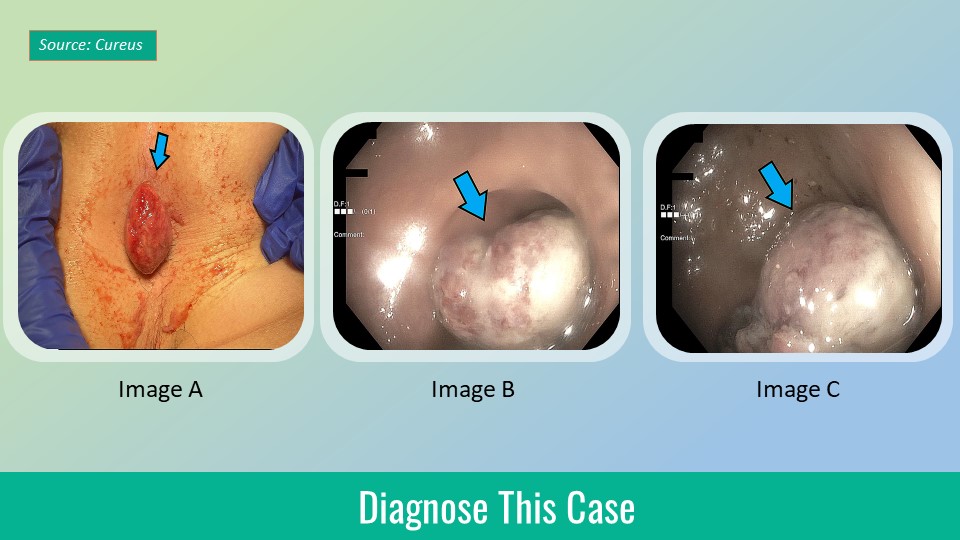 A Pediatric Case of Prolapsed Anorectal Mass