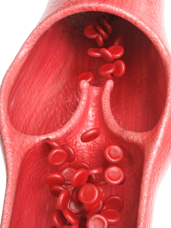 Therapies in Varicose Veins: Doctor’s Dialogue