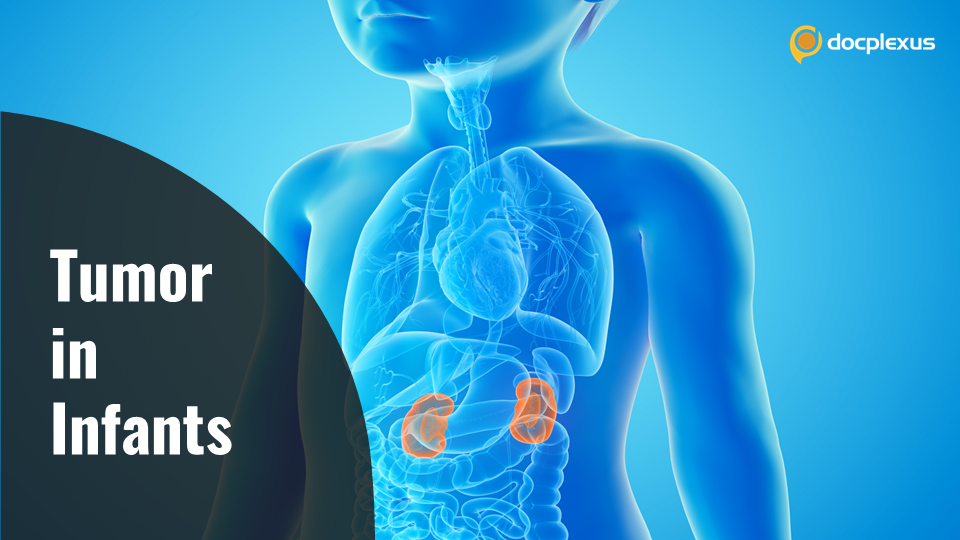 Kidney Cancer in Infants: Which is the Most Common Tumor?