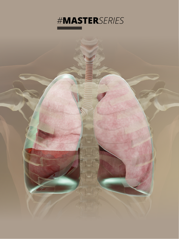 Malignant Pleural Effusion