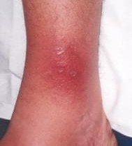 Identify This Skin Condition