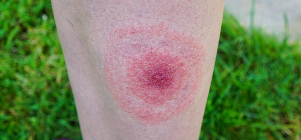Can You Diagnose This Skin Condition?