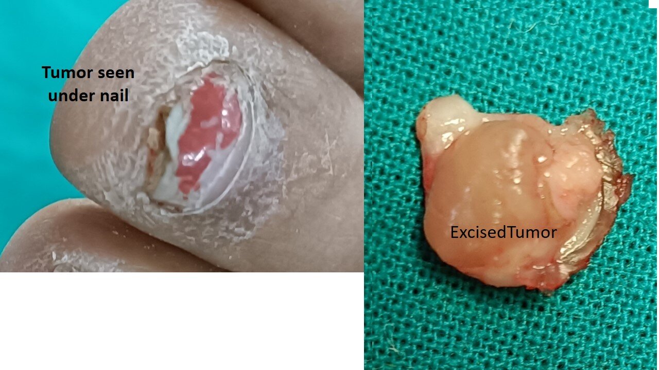 Glomus Tumor: A Case Report