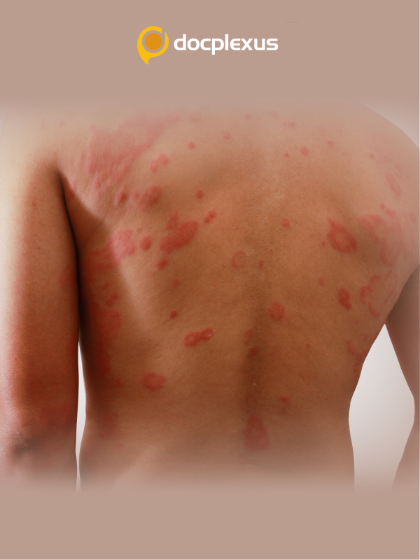 Atopic Dermatitis: Optimizing Outcomes
