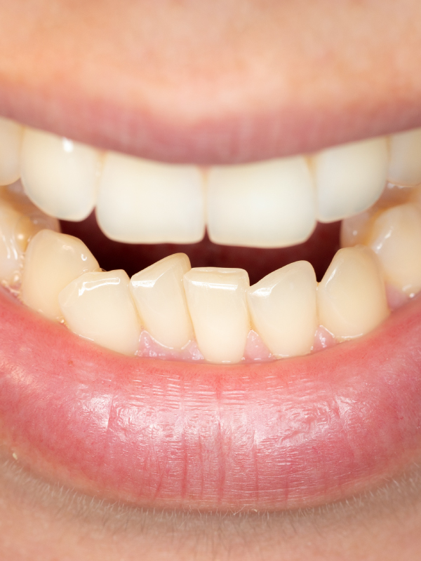 Vitamin D and Malocclusion