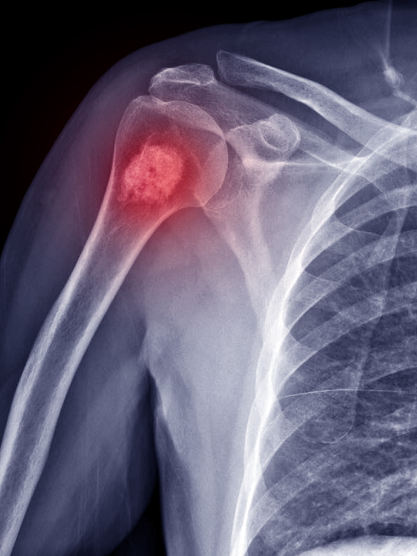 A to Z RAM (Radiological Assessment Method) for Bone Tumors: A Guide for Orthopedic Surgeons & Radiologists