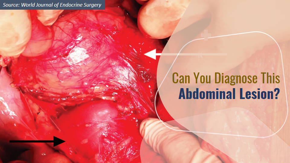 Case of a Man with Progressive Abdominal Pain - What’s Your Diagnosis?