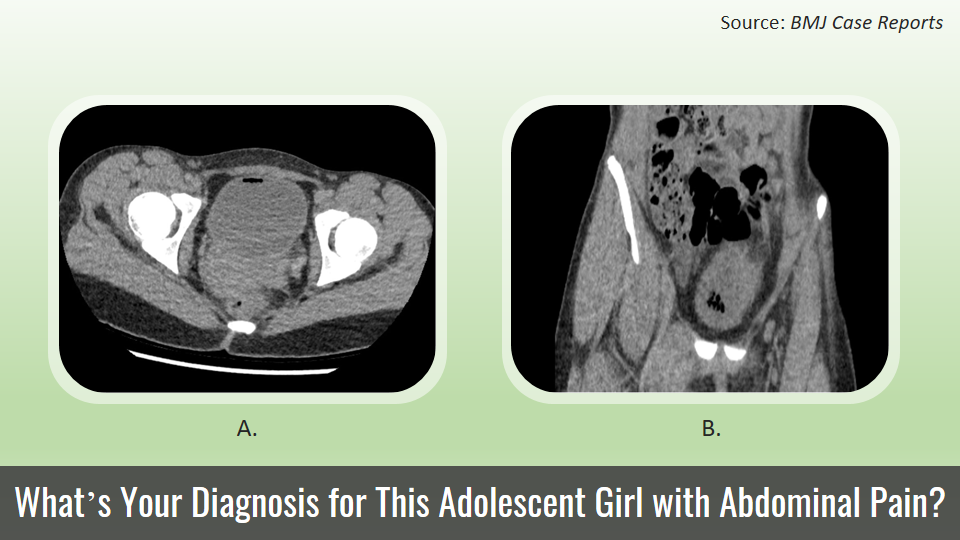Identify the Cause of Recurrent UTI, Ureteral Reflux, and Diffuse Abdominal Pain in This Girl