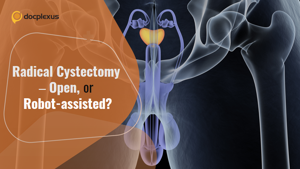 Is Robot-assisted Surgery a Better Alternative to Open Radical Cystectomy for Genitourinary Cancers?