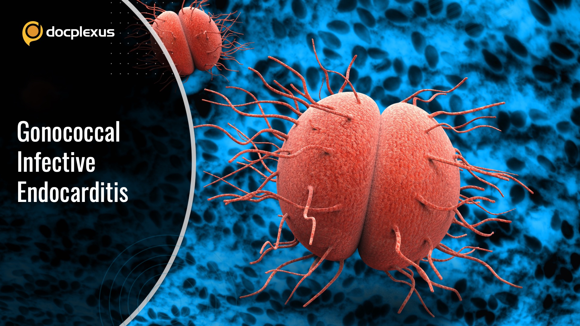Gonococcal Endocarditis: A Rare Complication of Gonococcal Infection