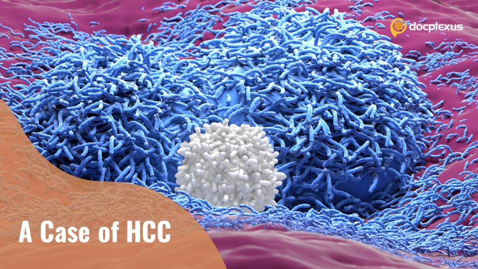 Hepatocellular Carcinoma in a 68-year-old Woman: Managing the Case