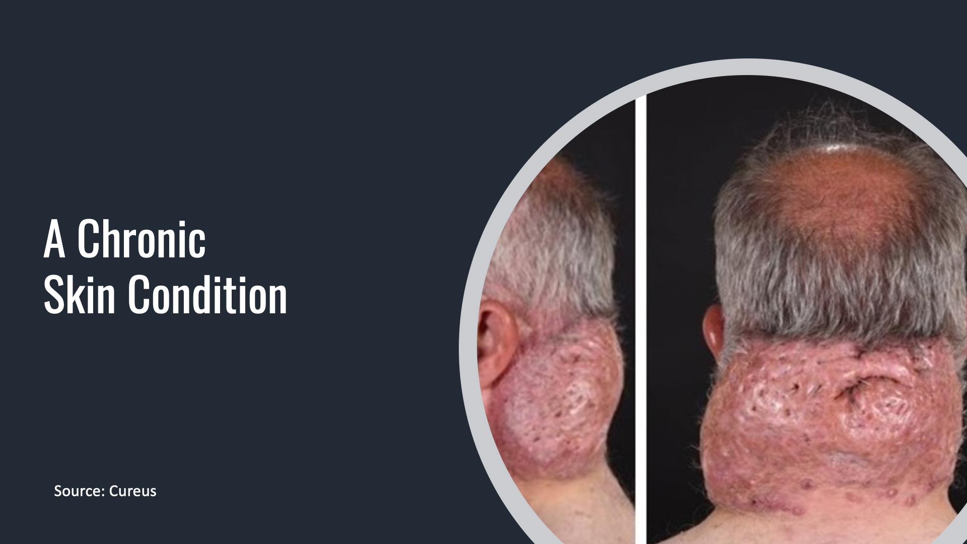 Identify the Cause of This Chronic Skin Condition