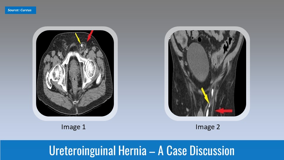 A Rare Case of Ureteroinguinal Hernia in 76-year-old Man