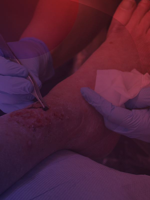 Recurrent Varicose Veins