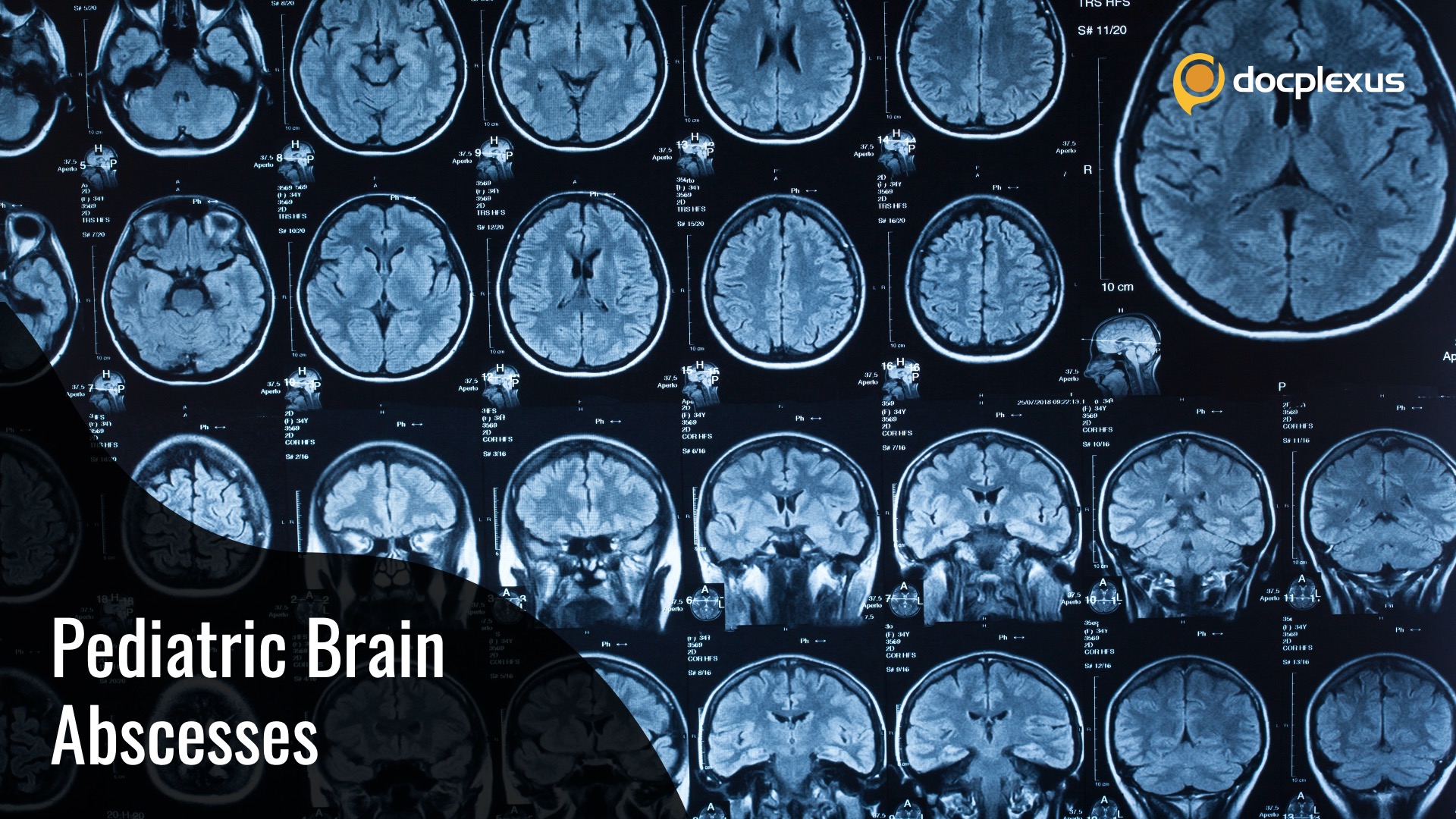 A Challenging Case of Pediatric Brain Abscess