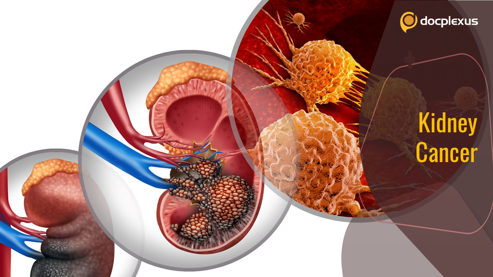 5 Things You Should Know About Kidney Cancer