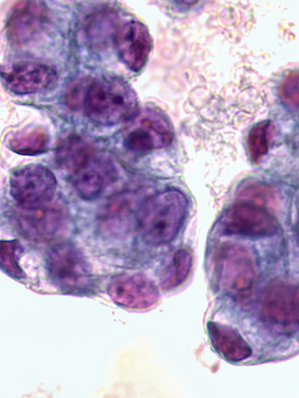 Malignant Pleural Effusion