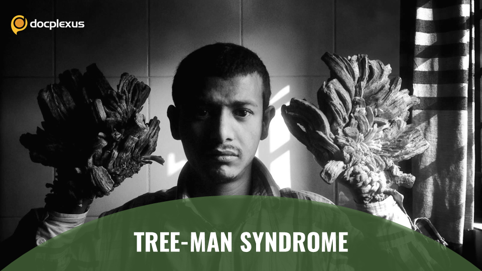 Epidermodysplasia Verruciformis: An Incredibly Rare Genetic Condition