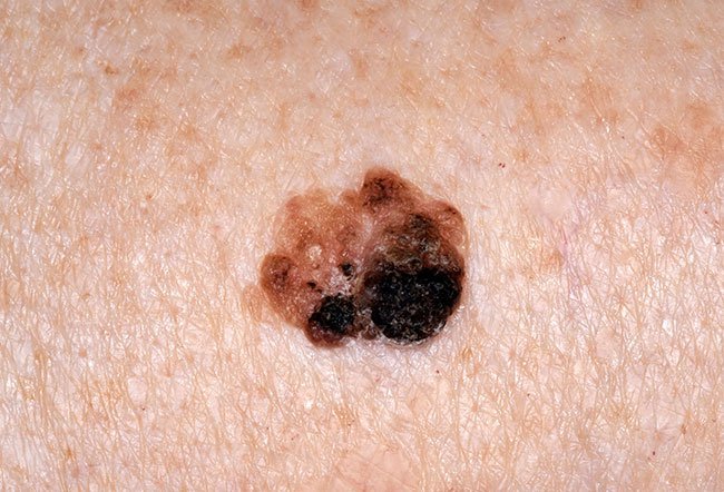 What Can Be The Management of This Unusual Skin Lesion?