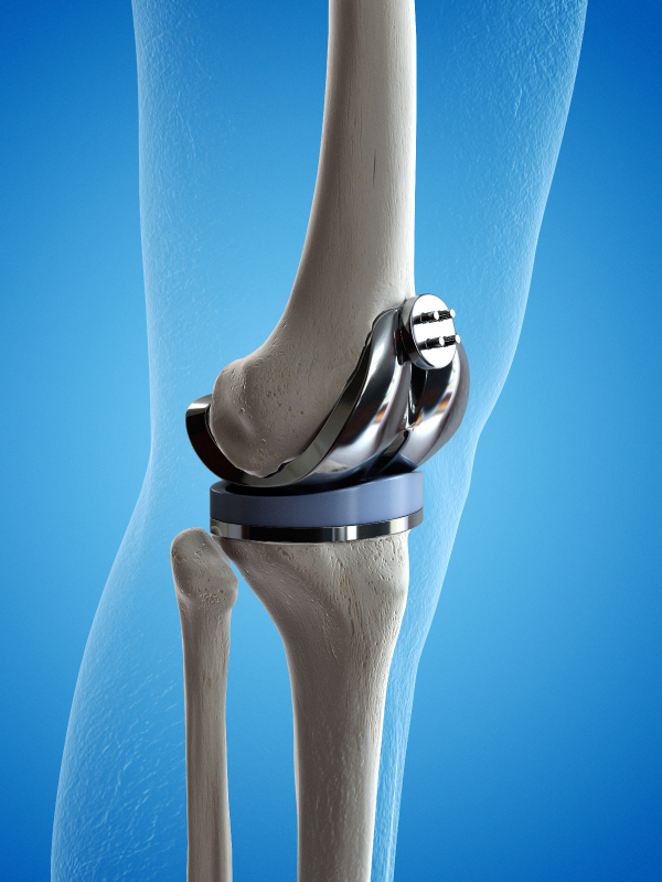 Unhappy Knees