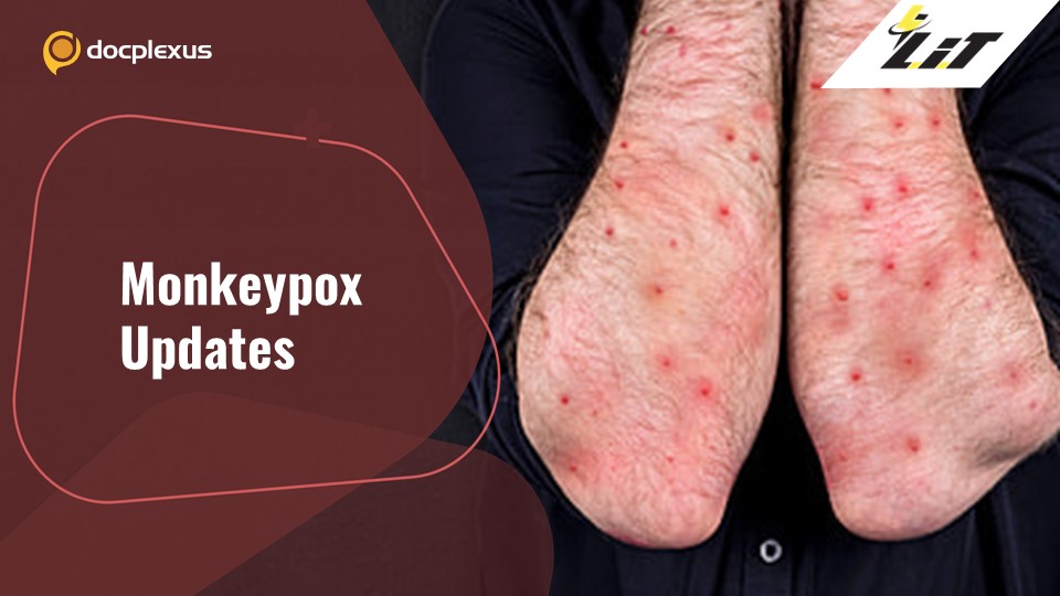 Monkeypox  – What Do We Know?