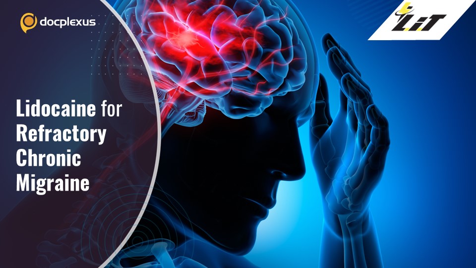 Managing Chronic Migraine with Lidocaine