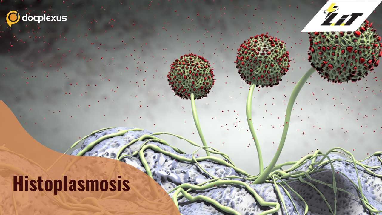 Histoplasmosis- An Opportunistic Infection