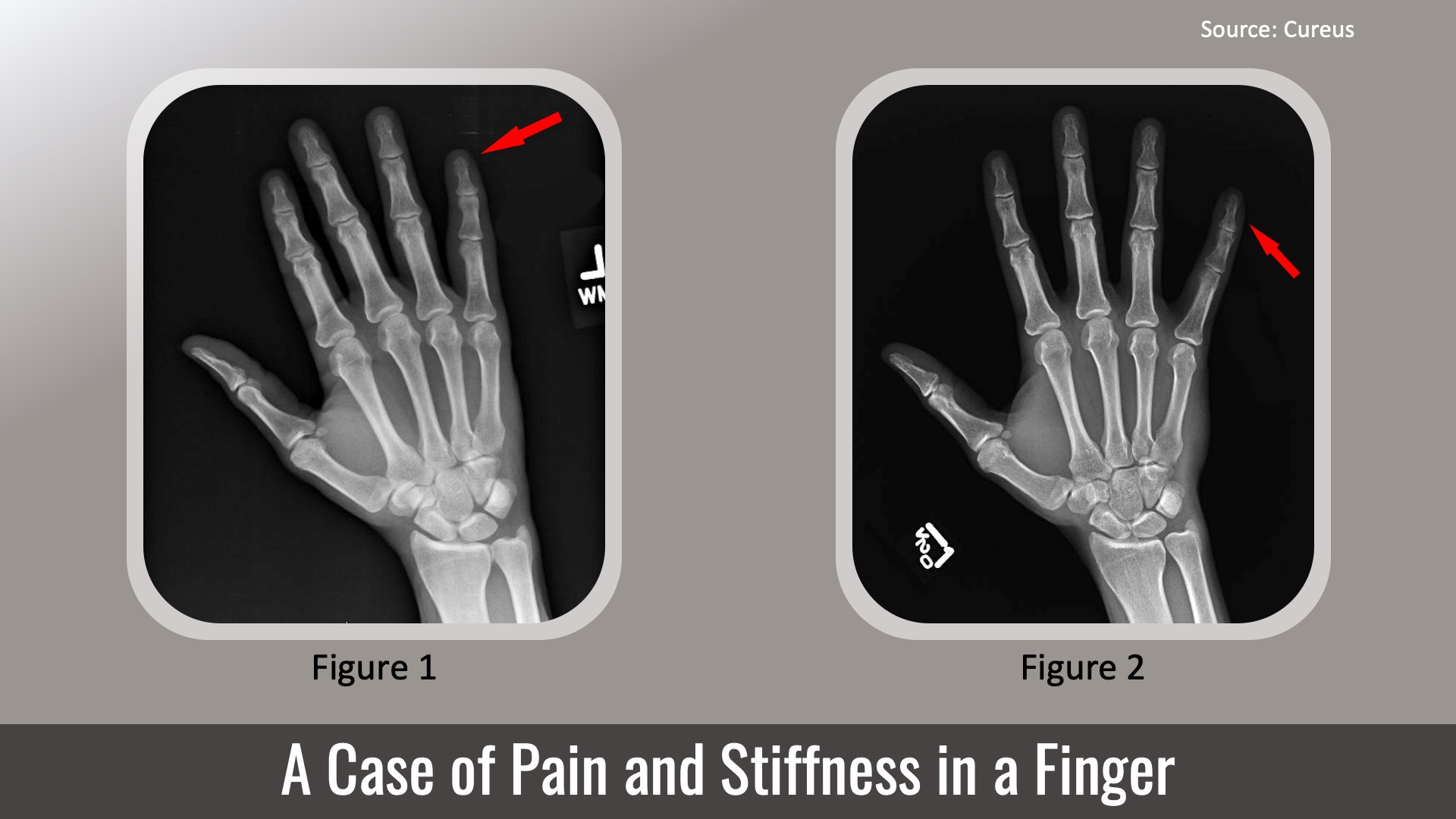 Identify the Cause of Pain and Stiffness in This Patient’s Small Finger