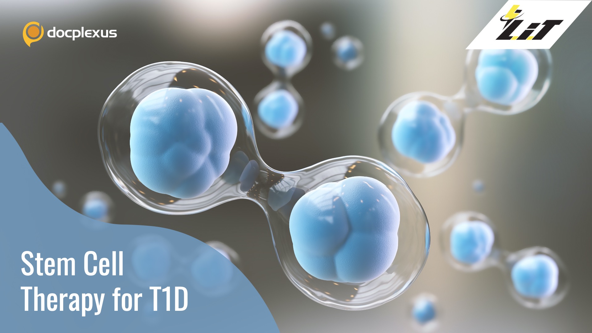 A New Promising Stem Cell Therapy for Patients with Type 1 Diabetes