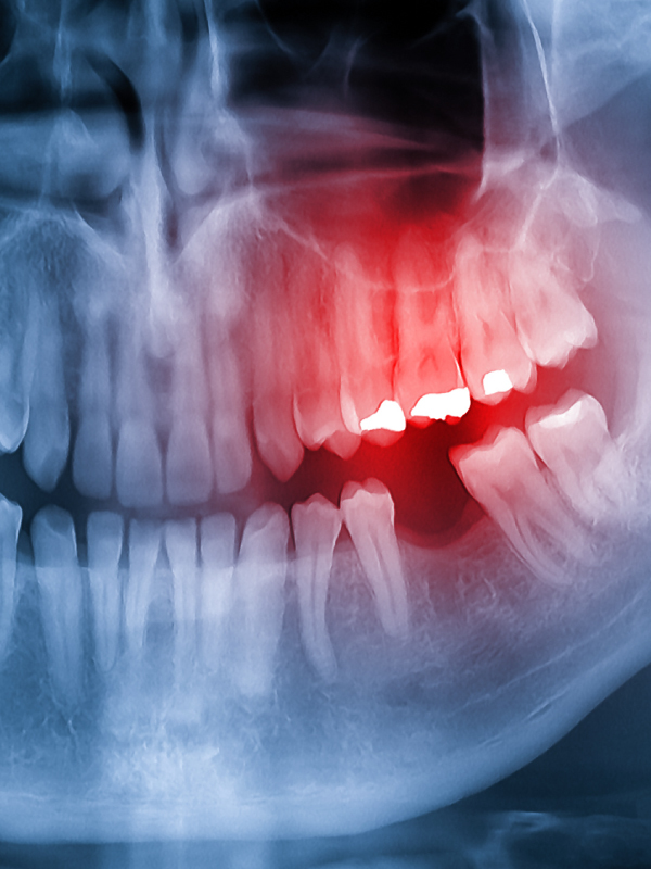 Diagnosis and Imaging of Oral and Maxillofacial Cancers