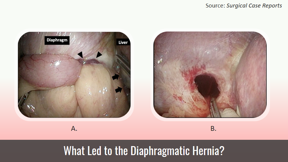Acute Epigastric Pain with History of HCC and Multiple RFA: What Could Be the Cause?