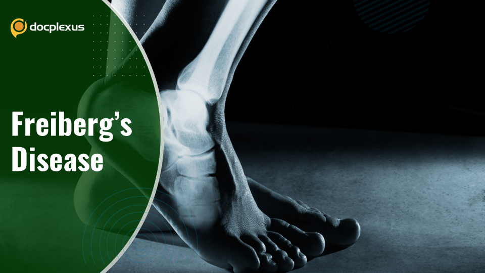 Freiberg’s disease: A Rare Foot Condition