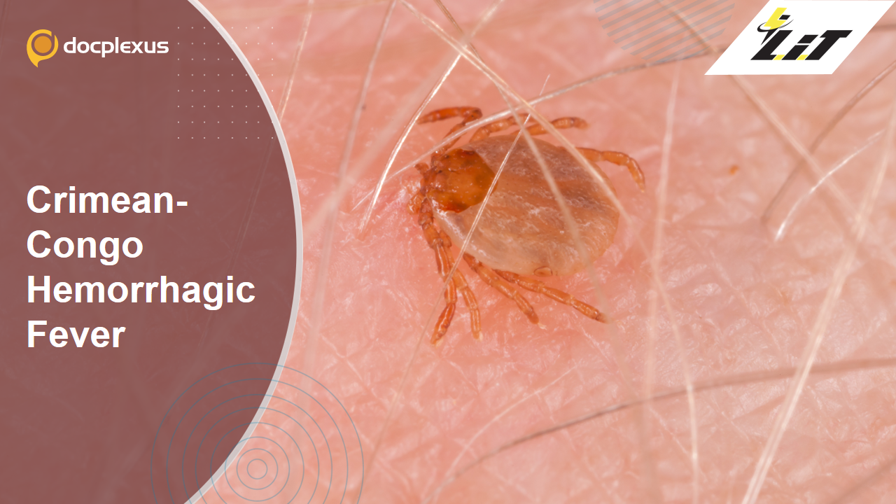 Crimean-Congo Hemorrhagic Fever – A New Epidemic?