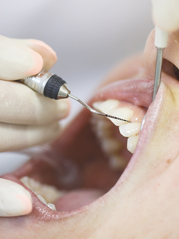 Periodontal Regeneration (Part II)