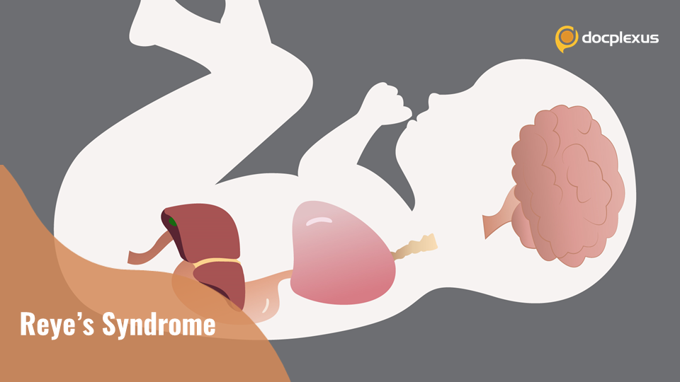 Reye’s Syndrome, Rare and Fatal