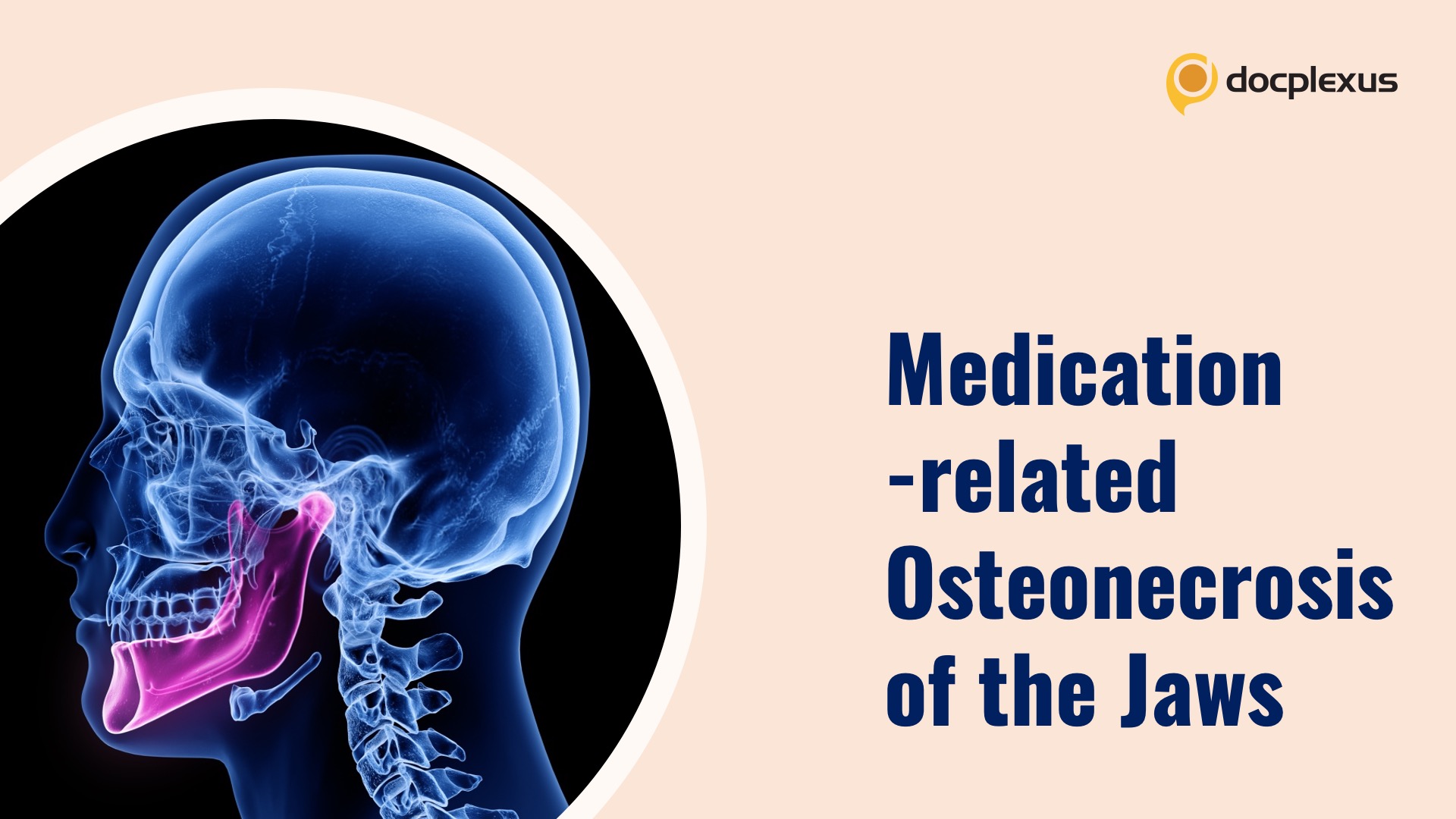 Osteonecrosis of the Jaws Induced by Medications - Management: AAOMS Management Guidelines Update (2022)
