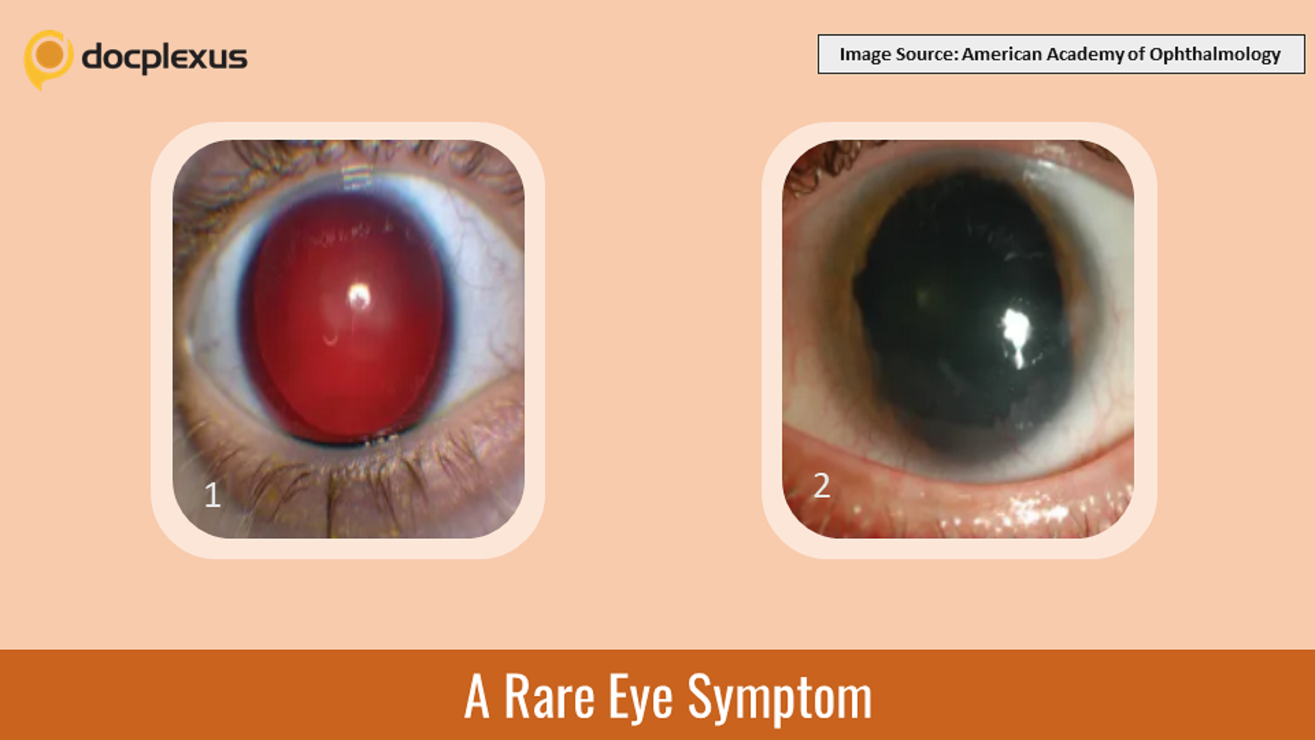 Can You Identify This Rare Eye Presentation?