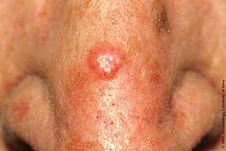 Tumor Growing on The Nose