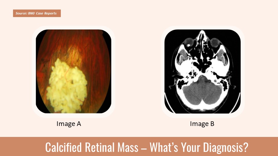 Identify the Cause of Photopsia in This 28-year-old Man