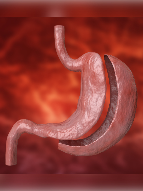 GERD After Sleeve: Evaluation and Management