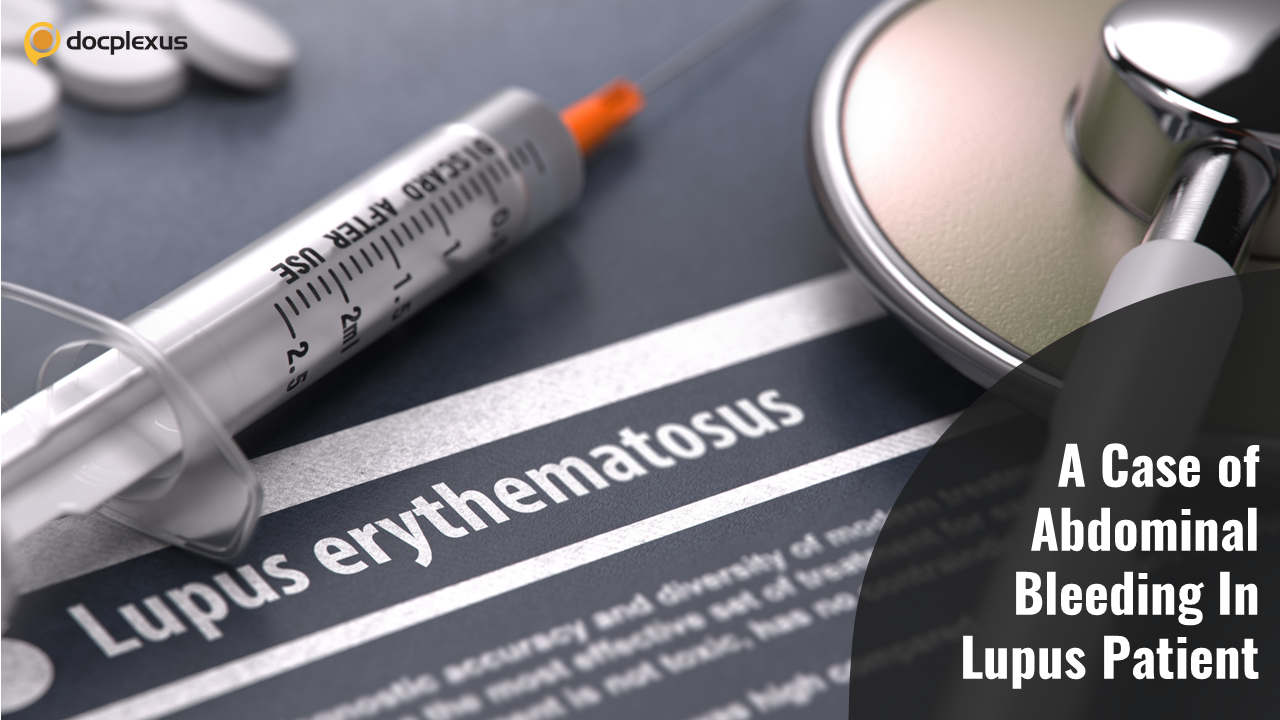 When Lupus Flared Up Due to Rectus Sheath Hematoma
