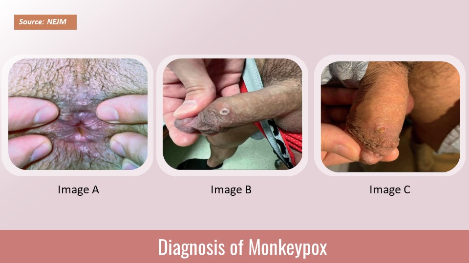 A Case of Monkeypox in a Homosexual Male: Diagnosis and Management