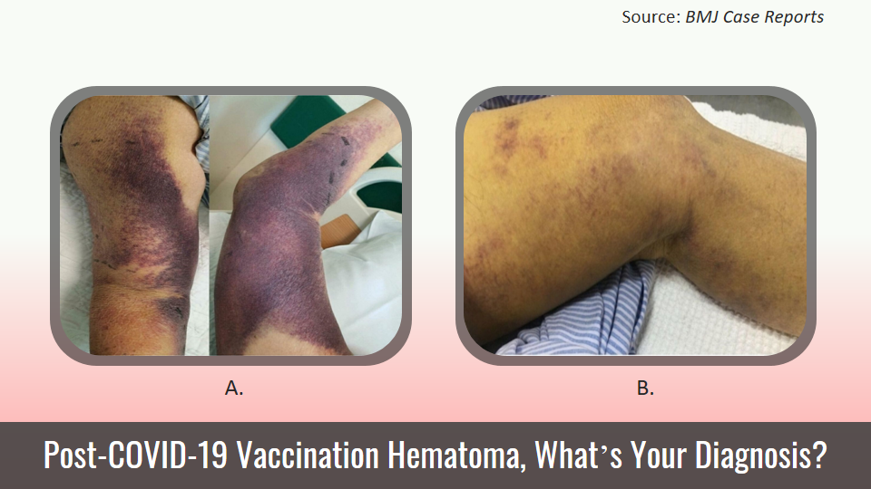 Case of an Elderly Man with Ecchymoses on His Limbs