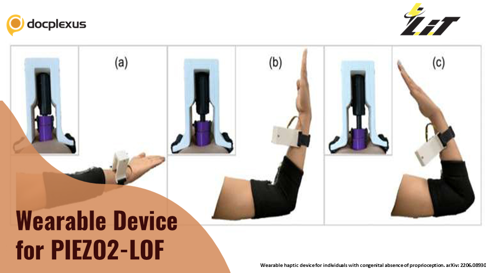 First Wearable Haptic Device for PIEZO-2 LOF