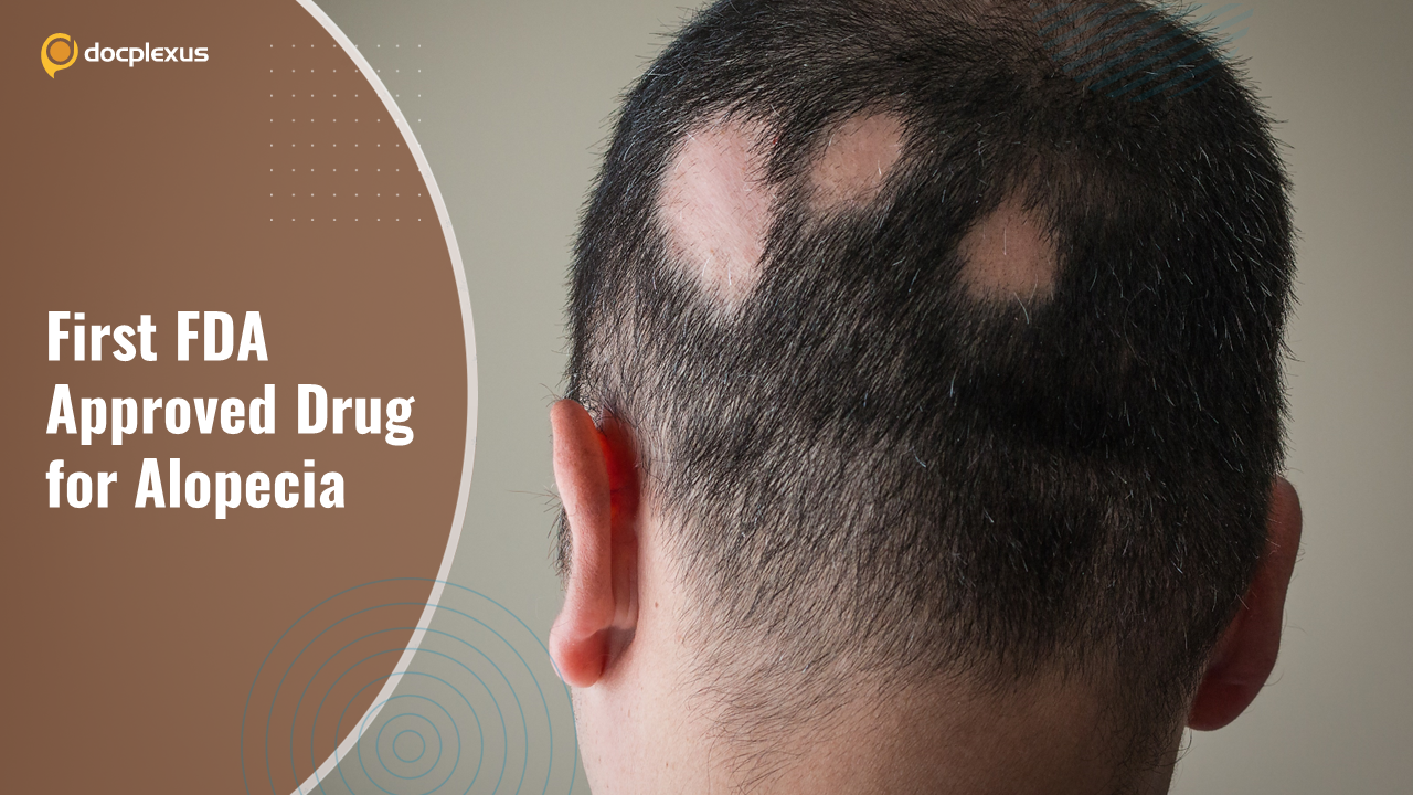 USFDA approves First Drug for Alopecia Areata