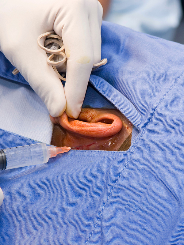 Stapedotomy Ear Surgery to Treat Otosclerosis